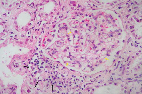 Figure 1. Glomerular basement membrane thickening (yellow arrows) and mononuclear cell infiltration (arrows) in kidney interstitium (HE, ×200). HE, Hematoxylin eosinophil.