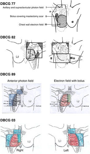 Figure 3.  DBCG 77: I: Anterior photon field including supra/infraclavicular region arid axillary region, lI: Bolus covered part of the anterior photon field. III: Anterior electron field. A: Reference point for mid-plane of axillary field and measurement of anterior-posterior diameter (A-P diameter). For further details, see Overgaard et al. Citation[18]. DBCG 82. Left: The anterior combined photon/electron 3-field technique which was most commonly used in the DBCG 82 b&c trials. Field I: anterior photon field. Fields II and III: anterior electron fields. Larynx and shoulder joint are blocked and a wax bolus covers the scar area in the photon field area. Right: The wide tangential field technique. Field I: anterior photon field, with blocking of larynx and shoulder joint. Fields II and II: opposed tangential photon fields with the medial field border being located 3 cm contralateral to midsternum. From Nielsen et al. Citation[45]. DBCG 89. Treatment fields to patients with ≥ 10 nodes removed. Left figure: Anterior photons fields to periclavicular and level 3 axillary nodes and lateral chest wall with lung blocks. Right figure: Anterior electron field covering remaining part of chest wall and IMN.DBCG 03. Treatment fields to patients with ≥ 10 nodes removed. Anterior combined photon and electron fields covering periclaviculary area, level 3 axillary nodes and chest wall. IMN only included in patients with right-sided tumours.