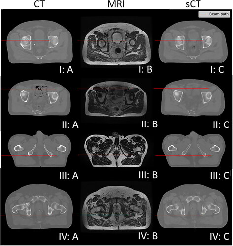 Figure 6. Comparison of CT (a), MRI (B) and corresponding sCT (C) for the same four exemplary patient slices (I-IV) as in Figure 5 with the simulated beam paths indicated as red lines.