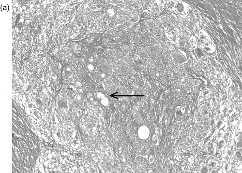 Fig. 2a.  H&E, 100x magnification. A large granuloma within collagenous tissue contains a central area of foamy epitheliod macrophages and empty lipid-like spaces (arrow), surrounded by a rim of multinucleate giant cells admixed with epithelioid cells and lymphocytes.