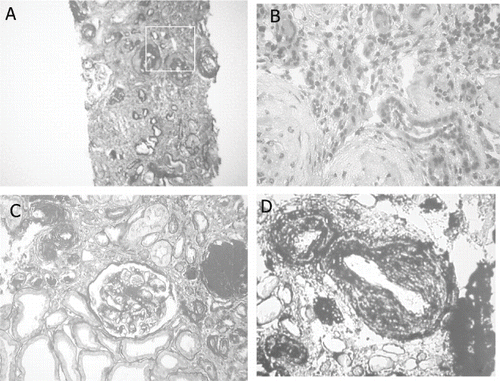 Figure 1 Renal biopsy findings. Panel 2A (PAS staining) shows the widening of interstitial areas with cellular infiltration and tubular dilatation. In 2B, two obsolescent glomeruli surrounded by intense interstitial infiltration are shown. 2C (PAS) shows a glomerulus with preserved structure and mesangial expansion, tubular dilatation, and atrophy, as well as areas of mesangial thickening; in the upper right-hand corner, two arterioles show appreciable wall thickening. 2D (silver methenamine staining) shows arterioles with myointimal proliferation.