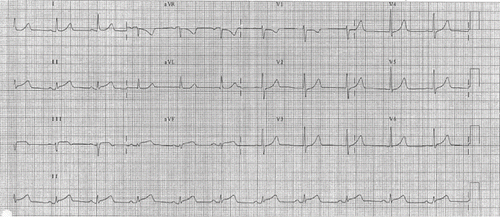 Fig. 1.  The electrocardiogram of the patient when she presented to the Accident and Emergency Department showing ST elevation over the inferior leads and ST depression over lead V1.