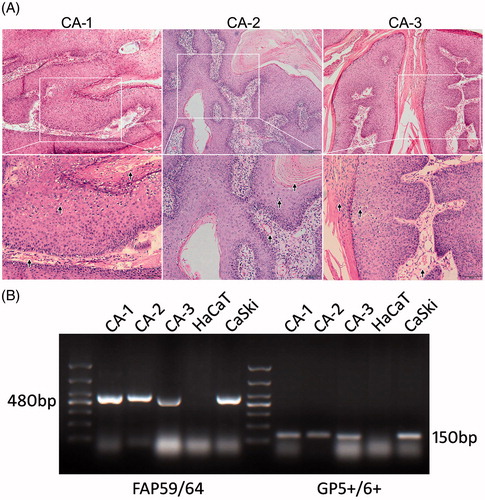 Figure 1. Diagnosis of CA. (A) HE staining and pathological examination of the samples dissected from the 3 samples of CA tissue. Arrows indicate partial characteristic pathological features that substantiate the diagnosis. (B) PCR amplification of HPV-DNA samples from the 3 tissue samples were separated by agarose gel electrophoresis. A 100 bp DNA ladder was used to illustrate DNA amplicon length. DNA from HaCaT cells were used as a negative control, whereas DNA from CaSki cells were used as a positive control.