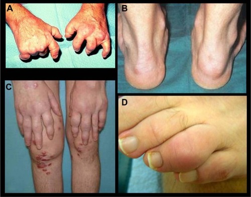 Figure 2 Psoriatic arthritis.