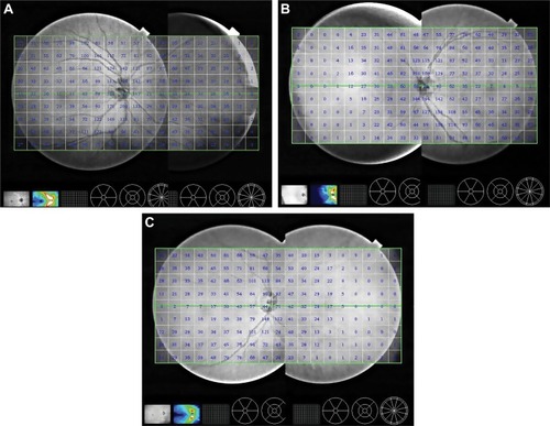 Figure 3 The representative composite images obtained from different age groups containing the retinal nerve fiber layer thickness data: (A) Group 1, (B) Group 2, and (C) Group 3.