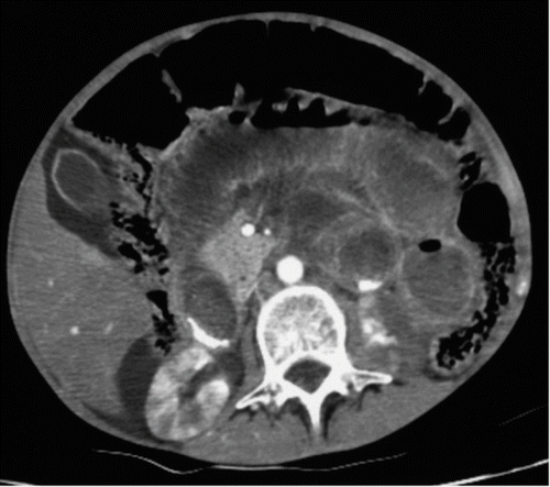 Fig. 2.  Early axial computed tomography scan of the upper abdomen with contrast showing colic dilatation, right cortical ischemic hyperdense kidney, and liver ischemia.