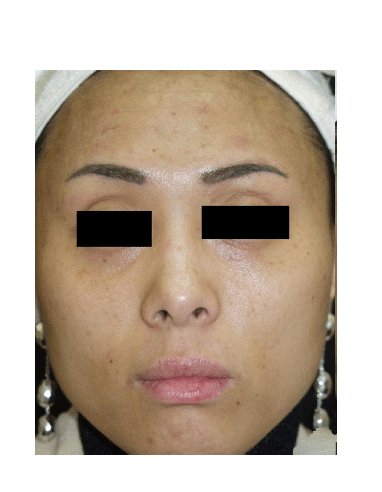 Figure 2. Clinical improvement with five sessions of 1064‐nm Q‐switched Nd:YAG (QSNY) laser treatment with low fluence at 2‐week intervals and one session of fractional photothermolysis system (FPS) therapy.