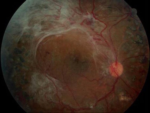 Figure 4. Tractional retinal detachment secondary to proliferative diabetic retinopathy. Note presence of neovascularization of the disc as well as elsewhere.