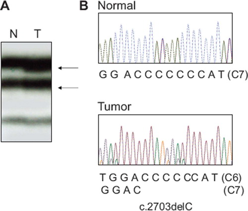 Figure 1. Mutation of HDAC4 exon 22 in a gastric carcinoma with MSI-H. A. PCR product of HDAC4 exon 22 from a gastric carcinoma shows aberrant bands (arrows in lane T) as compared to SSCP from normal tissue (N) of the same patient. B. Direct DNA sequencing analysis shows a heterozygous C deletion within the C7 in tumor tissue as compare to normal tissue.