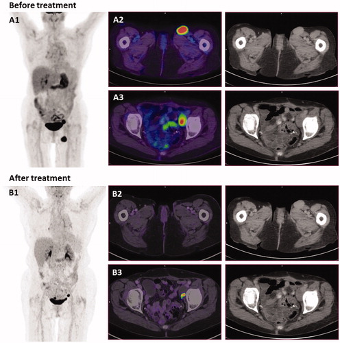 Figure 3. PET-CT scans and CT-scans before and after treatment. (A) September 2014, before treatment with electrochemotherapy. (A1) MIP image (maximum intensity projection), showing the two metastases. (A2) PET/CT scan shows an enlarged lymph node in the left inguinal region measuring 2.7 cm. (A3) An enlarged necrotic lymph node in the left side of pelvis measuring 2.4 cm. (B) July 2016, 16 months after electrochemotherapy and 12 months after retreatment with calcium electroporation and electrochemotherapy. (B1) MIP image shows disappearance of lymph node in the left inguinal region. (B2) PET/CT scan shows disappearance of lymph node in left inguinal region. (B3) Lymph node in left pelvis is almost completely necrotic, and cannot be measured. This inguinal node was subsequently biopsied and there was no sign of malignancy. Of note, a new PET/CT-scanner was employed for the second scan, thus direct comparison of the SUV values is not strictly possible.