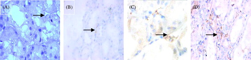 Figure 3. Immunostaining for C4d (DAB stain × 1000). (A) Negative C4d stain in PTC (arrow). (B) Minimal C4d stain/positive in PTC (arrow), i.e., C4d deposition in < 10% PTCs. (C) Focal C4d stain/positive in PTC (arrow), i.e., C4d deposition in 10–50% PTCs. (D) Diffuse C4d stain/positive in PTC (arrow), i.e., C4d deposition in > 50% PTCs.