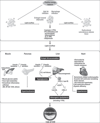 Figure 1. Schematic representation of abnormal visceral adipose tissue development leading to the storage of lipids at undesired sites. This phenomenon has been described as ‘ectopic fat’ deposition. According to this model, when energy intake is greater than energy expenditure, a dysfunctional subcutaneous adipose tissue may be unable to store appropriately the dietary energy excess, eventually leading to lipid overflow and to visceral fat deposition. This excess of visceral adiposity is associated with an altered free fatty acid metabolism with the release of adipokines as well as with adipocyte hypertrophy and increased fat storage in non-adipose organs, notably liver and skeletal muscle, and in other organs such as the pancreas and the heart. Excess adipocyte hypertrophy leads to ectopic fat storage and metabolic abnormalities such as insulin resistance, atherogenic dyslipidemia, hypertension, systemic inflammation, and eventually increases the risk of CVD.