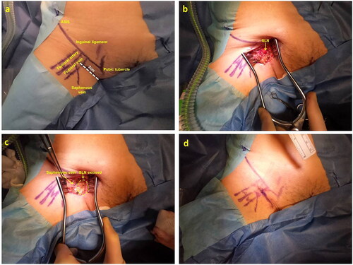 Figure 1. Surgical technique for sentinel lymph node (SLN) biopsy; a – landmark mapping prior to skin incision; b - the SLN is identified and isolated; c - post-excision of SLN; d - 3 cm skin incision closure following SLN biopsy.