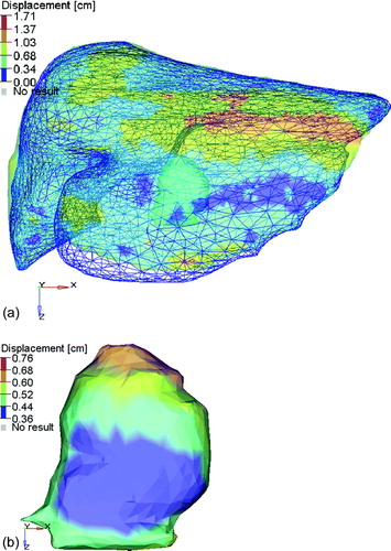 Figure 2.  Example of the residual deformation of the liver and tumor between the planning CT (shown in the colorwash) containing the delineated tumor (visible in the left lobe) and the liver defined on the kV CBCT (shown in the blue mesh). The displacements correspond to the vector magnitude of the displacements defined from the deformable registration using MORFEUS. (b) The vector displacement of the tumor, identified on the planning CT, between the position on the planning CT and the kV CBCT on treatment fraction 3. The change in COM was −0.36, −0.29, and 0.29 cm in the left-right, anterior-posterior, and superior-inferior directions, respectively.