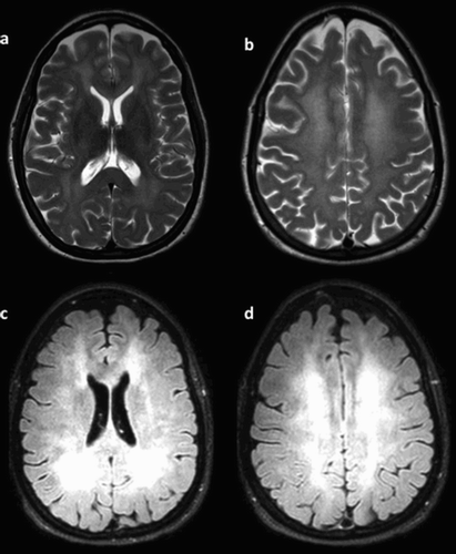 Figure 1. Magnetic resonance imaging of the brain showing diffuse white matter changes. (a) T2-weighted diffuse hyper-intensity involving the midbrain, insula, and basal ganglia bilaterally. (b) Bilateral symmetric reduced diffusion in periventricular white matter as seen on diffusion-weighted imaging (DWI). (c,d) FLAIR extent was graded severe.