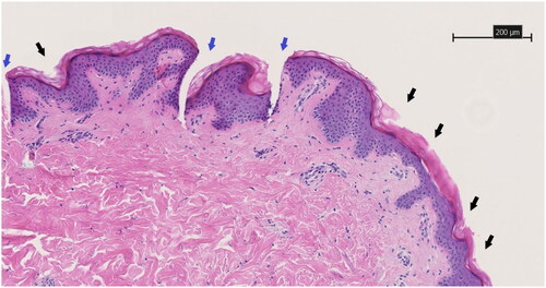 Figure 9. HE-stained 3 µm thick histological slice showing the skin piercing capability of the drug-embedded AUP-PCL530-HA MN. Black arrows show regular indentations of the epidermal layer and blue arrows show the pyramidical shaped penetration cavity through the epidermal layer toward the deeper dermal layer. Both are sequelae of microneedle application. The scale bar represents 200 µm. Magnification is 10x.