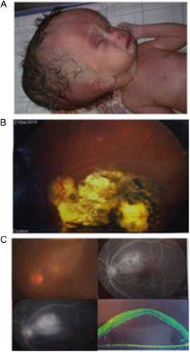 Fig. 2 Congenital toxoplasmosis in developing countries.Manifestations of ocular disease are common in congenital toxoplasmosis. However, the disease can be quite severe, and patients from Morocco, shown here, demonstrate significant severe cases. a Severe hydrocephalus can occur due to inflammation preventing resorption of cerebrospinal fluid (CSF) or obstructing flow of cerebrospinal fluid (CSF). This child was admitted to the Hôpital des Spécialités in Rabat, Morocco, and unfortunately did not survive due to the severity of his illness. b Ocular involvement is also common in congenital toxoplasmosis. Substantial scarring of the retina is also possible, and disruption of the retina can lead to loss of sight. c Progression of an ocular lesion in a congenitally infected 19-year-old patient. Ocular lesions progress without adequate treatment and can involve the formation of subretinal fluid and choroidal neovascular membranes (observed using optical coherence tomography)