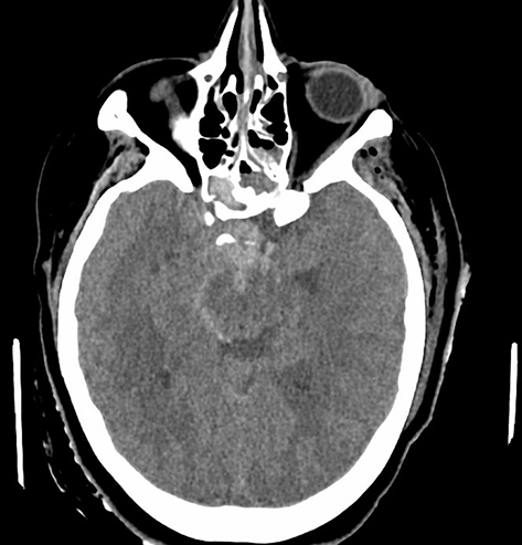 Figure 4 Axial view of the CT showing subarachnoid hemorrhage.