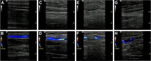 Figure 1 Two-dimensional and color Doppler flow imaging (CDFI) of different classifications of peripherally inserted central catheter thrombosis. (A) and (B) No thrombosis, complete compressibility of the vein with smooth vascular lumen. (C) and (D) Class I thrombosis, visible small clumps with low echo in lumen of vein and/or catheter outer wall, CDFI showing good blood flow and a vascular stenosis degree of 1%–30% with slight detectable blood flow. (E) and (F) Class II thrombosis, the presence of thrombosis clot in the vessel lumen and/or catheter outer wall, CDFI showing detectable blood flow and about 31%–50% vascular stenosis. (G) and (H) Class III thrombosis, complete blocking thrombosis with a large part of visible fusion of clot, CDFI showing only part signal of blood flow or no flow signals through narrow channel with vessel cross-sectional stenosis greater than 50%.