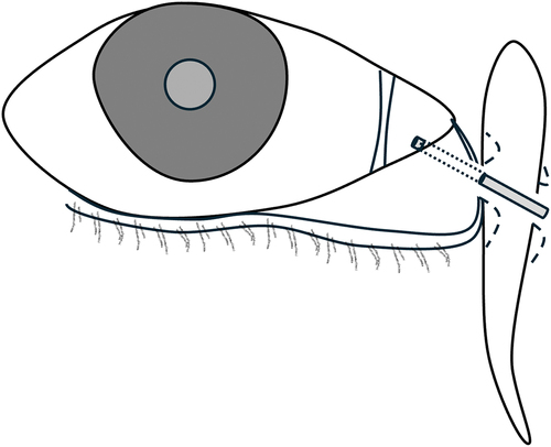Figure 4. LT Jones’ Conjunctivodacryocystorhinostomy with Jones tube.