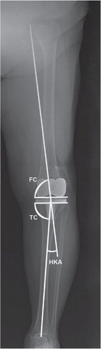 Figure 2. Standing anterior-posterior radiograph with a varus malalignment. Mechanical axis as hip-knee-ankle (HKA) and component alignment angles are represented. The HKA angle is the angle formed between the mechanical femoral and tibial axes. The femoral component (FC) angle is the angle medially between the distal surfaces of the femoral component and the femoral mechanical axis. The tibial component (TC) angle is the medial angle between the tibial component plateau and the tibial mechanical axis.