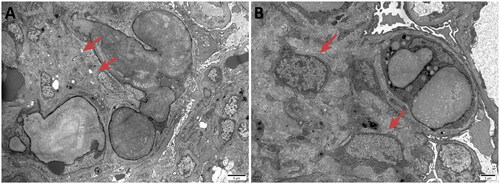 Figure 4. Electron microscopy: Proliferative lesions of mesangial matrix (4 A) and mesangial cells (4B) were observed in the renal specimen.