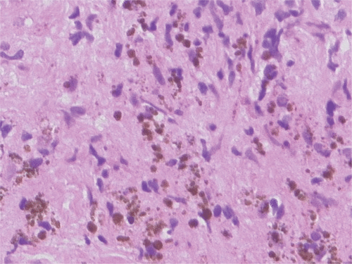 Figure 3. Histological image obtained by prostate biopsy one year after direct magnetic fluid injection into the prostate and thermal treatment. Iron-oxide nanoparticles are still present in the prostate tissue (haematoxylin-eosin staining, ×200).