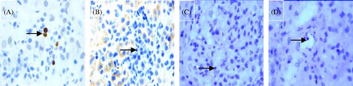 Figure 5. Immunostaining for Foxp3 (DAB stain × 1000). (A) Foxp3-positive controls. (B) Foxp3-negative controls (arrow). (C) Foxp3-negative T lymphocytes in the glomerulus (arrow). (D) Foxp3-negative T lymphocytes in the PTC (arrow).