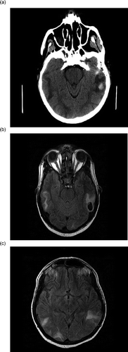 FIGURE 1. (a) A focus of hemorrhage in the left temporal area with associated edema. An MRI of the brain showing extensive multifocal parenchymal areas of edema, with hemorrhage (b) in the left temporal lobe and (c) in the inferior temporal gyrus region.