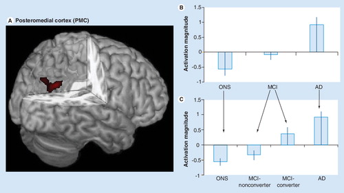 Figure 1. (A) The functional region of interest in the posteromedial cortex (PMC) used in our studies is shown in red and overlaid on a 3D canonical T1-weighted brain template image with posterior cortex cutout. (B) Activation magnitude parameter estimate (with standard error bars) in the PMC region (A). In this region, parameter estimates for activation magnitude demonstrated a lesser-to-greater activation from control (ONS), to MCI to AD subjects. (C) Activation magnitude parameter estimate (with standard error bars) in the PMC region (A), demonstrating a continuum from control (ONS), to MCI-nonconverter, to MCI-converter to AD. There were statistically significant (p < 0.05) differences between all groups with the exception of the control and MCI-nonconverter group, and the AD and MCI-converter group. An overall pattern of negative activation magnitude in the control and MCI-nonconverter groups and positive activation magnitude in the AD and MCI-converter groups is evident.AD: Alzheimer’s disease; MCI: Mild cognitive impairment; ONS: Older normal subject.