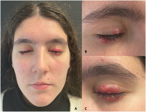 Figure 1. Clinical picture of the patient pretreatment. (A) Face overview with papules, pustules, redness, and periocular granulomatous rosacea involvement. (B) Close view of the right eye. (C) Close view of the left eye.