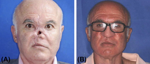 Figure 17. (A) Initial appearance of patient's face with injury from accidental gunshot. (B) Final prosthesis on patient. Adapted from reference (Citation41) with permission of Journal of Rehabilitation Research and Development, U.S. Department of Veterans Affairs, Copyright 2010.