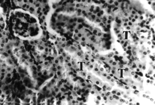 Figure 9 Kidney section of group 3 (1.0 g/kg feed) mouse collected on day 21 of treatment showing degeneration and necrosis of epithelial cells lining the tubules (T). H&E stain, ×400.
