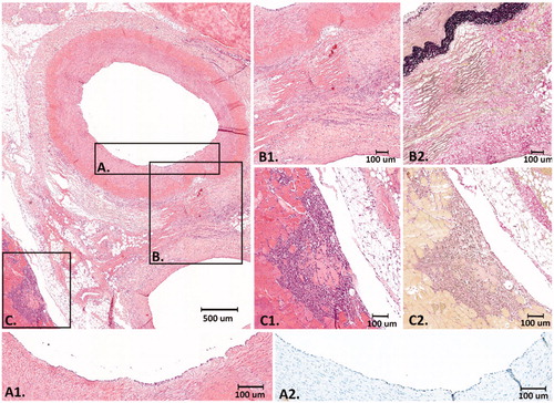 Figure 5. Histology after 3 days FUP. At the upper left panel an overview of the EFA, vein and part of the surrounding connective tissue and muscle is shown (H&E). (A) Higher magnification of the intimal layer of the EFA that was completely intact with presence of endothelial cells (A1. H&E and A2. ERG immunostain) (B) Higher magnification of the medial and adventitial layer of the EFA and the connective tissue in between the artery and vein that revealed fibrinoid, reactive, changes with activated fibroblasts and macrophages (B1. H&E and B2. Elastic van Gieson stain). (C) Higher magnification of the striated muscle with an inflammatory infiltrate with macrophages around some necrotic striated muscle cells (C1. H&E and C2. Elastic van Gieson stain).