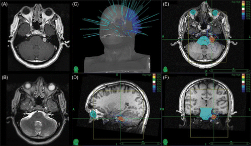Figure 2. Representative MRI and treatment plan for acoustic neuroma: (A) axial gadolinium-enhanced T1 MRI image; (B) axial T2 MRI image; (C) non-isocentric beam paths; (D) sagittal view of treatment plan; (E) axial view of treatment plan; and (F) coronal view of treatment plan.