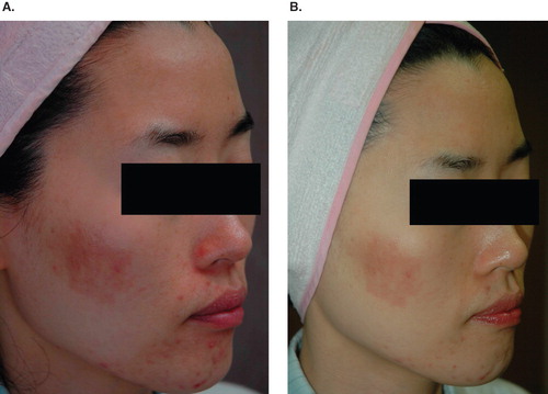 Figure 2. An erythematous to brownish patch on the cheek appeared after the combined 1550-nm erbium-doped laser and 10 600-nm CO2 fractional photothermolysis system therapy (A: 2 weeks after treatment; B: 4 weeks after treatment).
