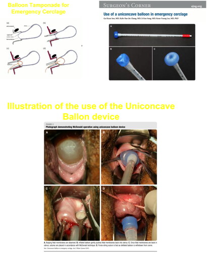 Figure 3. Placement of balloon to reduce membranes prior to cerclage insertion with Uniconcave catheter (Courtesy of Lv et al. 2000) [Citation77].