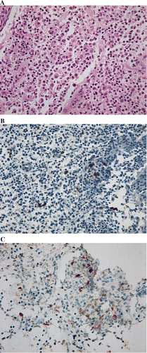 Figure 6.  Histopathologic findings. Histopathologic examination reveals a proliferation of histiocytes with an infiltration of eosinophils. These histocytes were positive for S-100 (B), and for CD-1a (C). Original magnification ×400.