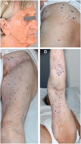 Figure 2. July 2016. Illustration of widespread vitiligo in treated and untreated areas. (A) Vitiligo in distant untreated area. (B–D) Vitiligo extends beyond the actual treated area.