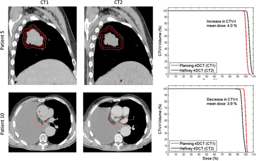 Figure 3. Examples of anatomical changes from the planning 4DCT scan (CT1) to the 4DCT scan (CT2). GTV-t is contoured in red and CTV-t is contoured in pink. Upper panel: Sagittal view of Patient 5 illustrating tumor shrinkage in CT2, and (right) dose volume histograms (DVHs) showing the resulting impact on the CTV-t dose. Lower panel: Transversal CT slices of Patient 10 treated with post-operative RT, illustrating pleural effusion in CT2, and DVHs for CTV-t.