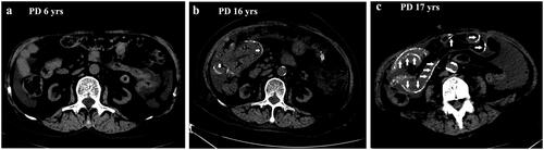 Figure 1. The abdominal CT images of the patient at the 6th year, 16th year, and 17th year on PD therapy. No EPS sign at 6th year on PD therapy (a); mildly calcified fibrous peritoneal membrane and the bowel (short arrow) at 16th year on PD therapy (b); typical peritoneal thickening, extensive calcification of the intestinal walls (long arrow), dilatation of small bowels at 17th year on PD therapy (c).