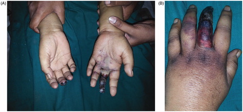 Figure 1. Dry gangrene of (A) left middle finger extending till the base and (B) the tip of right middle finger.