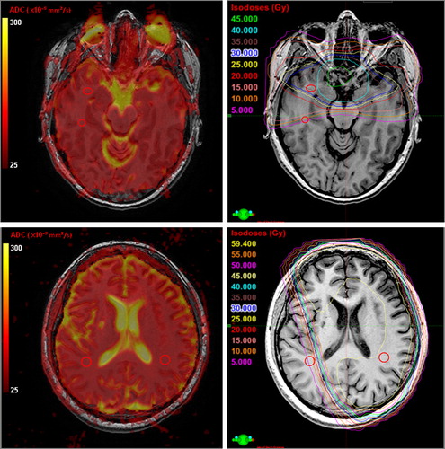 Figure 1. Top row: patient with pituitary adenoma, example of ROI placement in parallel white matter areas. The ROI size is based on a 66 mm2 circle, reduced in each case to the largest circular/oblong ROI that fit the white matter area between the relevant dose lines. Bottom row: patient with astrocytoma grade III, example of ROI placement in paired white matter areas. Left column: ADC-map placed as an unsmoothed overlay on T1 weighted images. Right column: Dose plan with absolute dose in steps of 5 Gy placed as an overlay on the T1 weighted images.