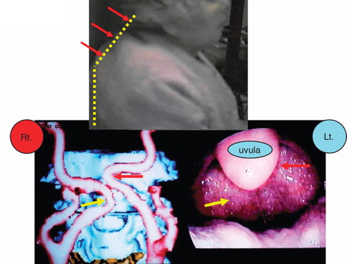 Figure 1. Top: actual bent-posture in an 84-year-old female.(yellow dots). Lower: three-dimensional computed tomography (CT) showing aberration of the internal carotid artery on both sides. Aberrant carotid arteries in the mouth. A submucosal swelling pulsates in synchrony with the patient's heartbeat. Aberration of the internal carotid artery. Reproduced with permission from Tsunoda K et al. Ann Intern Med 2003;139:W-56 [Citation8].