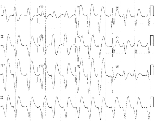 Figure 1. Electrocardiogram for patient 2 at approximately 70 minutes after ingestion of approximately 1 g of flecainide. QRS = 268 msec; uncorrected QT = 572 ms; QTcB = 644 ms.