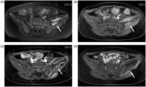 Figure 1. Transverse MR in a 19-year-old girl with Ewing’s sarcoma in the left ilium who received curative HIFU ablation. (A) The tumour margin (arrow) was shown on T2-weighted MR before HIFU ablation. (B) The tumour (arrow) showed rich enhancement on T1-weighted contrast-enhanced MR before HIFU ablation. (C) One month after HIFU ablation, the ablation area (arrow) enveloped the entire tumour, which showed no enhancement on T1-weighted contrast-enhanced MR. (D) One year after HIFU ablation no enhancement was found in the ablation area (arrow) on T1-weighted contrast-enhanced MR.