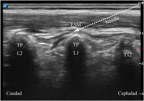 Figure 1. Longitudinal parasagittal ultrasound image of erector spinae plane block performed at the L1 transverse process. ESM: erector spinae muscle; TP: transverse process; T12: twelfth thoracic vertebra; L1: first lumbar vertebra; L2: second lumbar vertebra.