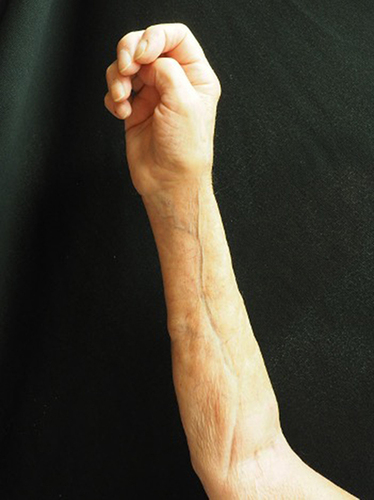 Figure 10 The groove sign of eosinophilic fasciitis is characterized by linear indentations of skin along the superficial veins of the forearm.
