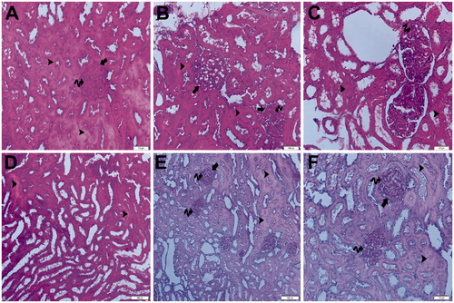 Figure 13. (Ischemia/reperfusion group) (A) Light microscopy of a glomerulosclerosis (spiral arrow) demonstrating and Bowman’s space lose (arrow). Many tubules show dense hyaline casts (arrow head). H&E stain. (B) Light microscopy of a glomerulosclerosis (spirally arrow) demonstrating and Bowman’s space lose (arrow). Many tubules show dense hyaline casts (arrow head). H&E stain. (C) Light microscopy of a glomerulosclerosis (spirally arrow). Many tubules show necrotic tubules (arrow head). H&E stain. (D) Light microscopy of a many tubules showing dense hyaline casts (arrow head).H&E stain. (E) Light microscopy of a glomerulosclerosis (spirally arrow) demonstrating and Bowman’s space lose (arrow). Many tubules show dense hyaline casts (arrow head). PAS stain. (F) Light microscopy of a glomerulosclerosis (spirally arrow) demonstrating and Bowman’s space lose (arrow). Many tubules show dense hyaline casts (arrow head). PAS stain.