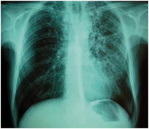 Figure 1. Chest X-ray at presentation showing bilateral infiltrates.